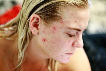 Voedingsmiddelen die tot acne leiden